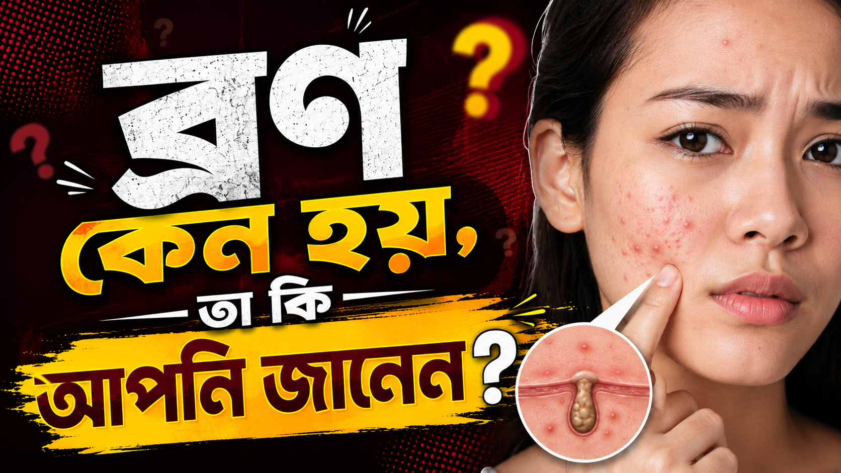 ব্রণ কেন হয় জেনে নিন ব্রণ হওয়ার ৫টি প্রধান কারণ ও করণীয়